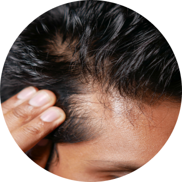 Dandruff / Scalp Health